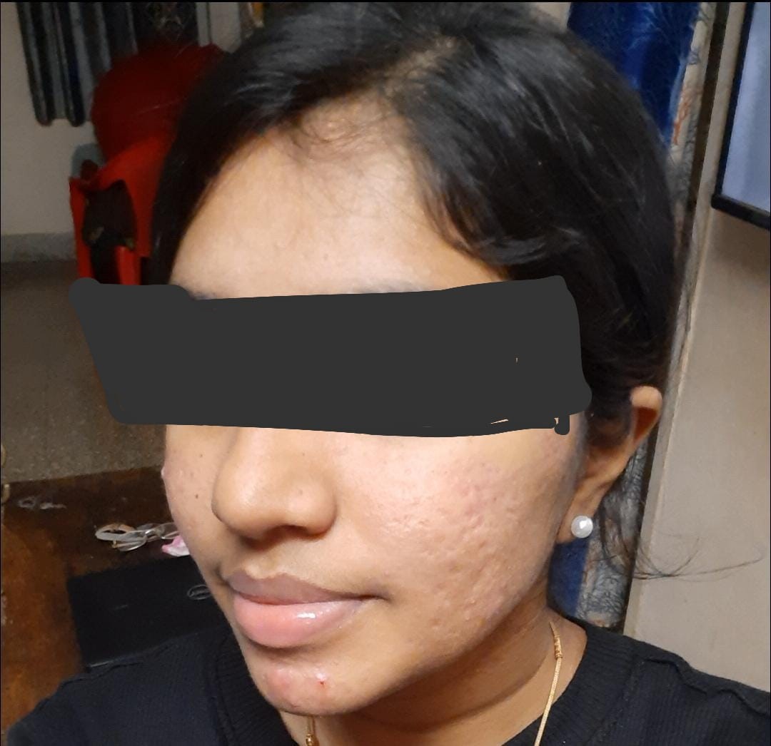 Acne Vulgaris 7